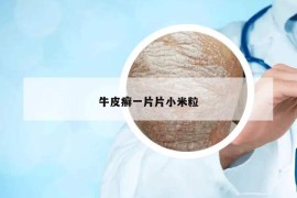 牛皮癬一片片小米粒