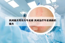 民間偏方奇效方牛皮癬 民間治療牛皮病癬的偏方