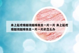 身上起疙瘩越撓越癢而且一片一片 身上起疙瘩越撓越癢而且一片一片的怎么辦