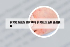 割耳放血能治銀屑病嗎 割耳放血治銀屑病視頻