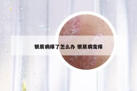 銀屑病癢了怎么辦 銀屑病變癢
