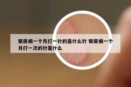 銀屑病一個(gè)月打一針的是什么針 銀屑病一個(gè)月打一次的針是什么