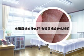 有銀屑病吃什么好 有銀屑病吃什么好呢