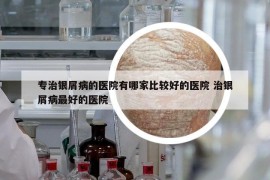 專治銀屑病的醫(yī)院有哪家比較好的醫(yī)院 治銀屑病最好的醫(yī)院