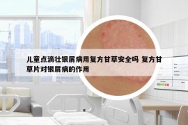 兒童點(diǎn)滴壯銀屑病用復(fù)方甘草安全嗎 復(fù)方甘草片對(duì)銀屑病的作用