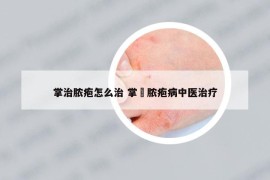 掌治膿皰怎么治 掌踀膿皰病中醫(yī)治療