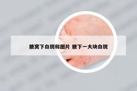 腋窩下白斑和圖片 腋下一大塊白斑