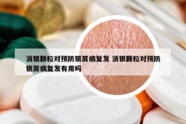 消銀顆粒對預(yù)防銀屑病復(fù)發(fā) 消銀顆粒對預(yù)防銀屑病復(fù)發(fā)有用嗎