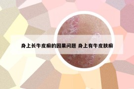 身上長牛皮癬的因果問題 身上有牛皮膚癬
