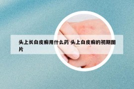 頭上長(zhǎng)白皮癬用什么藥 頭上白皮癬的初期圖片