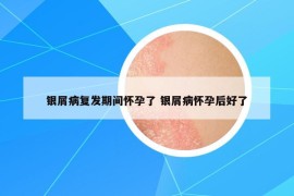 銀屑病復(fù)發(fā)期間懷孕了 銀屑病懷孕后好了