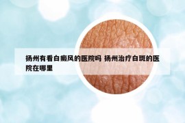 揚州有看白癜風(fēng)的醫(yī)院嗎 揚州治療白斑的醫(yī)院在哪里