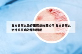復(fù)方青黛丸治療銀屑病效果如何 復(fù)方青黛丸治療銀屑病效果如何啊