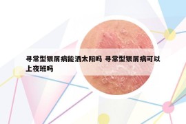 尋常型銀屑病能灑太陽(yáng)嗎 尋常型銀屑病可以上夜班嗎