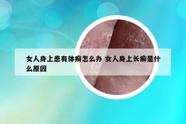 女人身上患有體癬怎么辦 女人身上長癬是什么原因