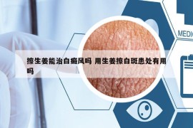擦生姜能治白癜風(fēng)嗎 用生姜擦白斑患處有用嗎