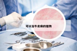 可以治牛皮癬的植物