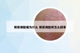 銀屑病腿痛為什么 銀屑病腿疼怎么回事