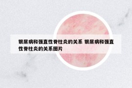 銀屑病和強直性脊柱炎的關系 銀屑病和強直性脊柱炎的關系圖片