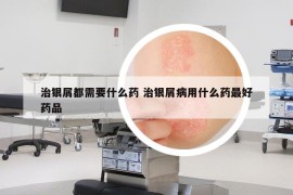 治銀屑都需要什么藥 治銀屑病用什么藥最好藥品