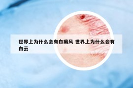 世界上為什么會(huì)有白癜風(fēng) 世界上為什么會(huì)有白云