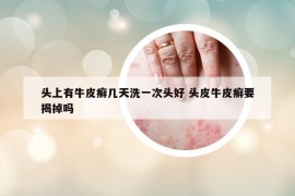 頭上有牛皮癬幾天洗一次頭好 頭皮牛皮癬要揭掉嗎