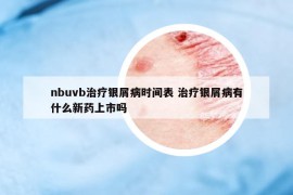 nbuvb治療銀屑病時(shí)間表 治療銀屑病有什么新藥上市嗎