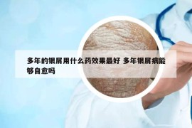 多年的銀屑用什么藥效果最好 多年銀屑病能夠自愈嗎