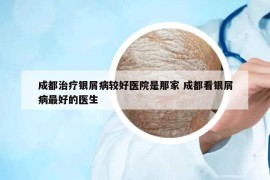 成都治療銀屑病較好醫(yī)院是那家 成都看銀屑病最好的醫(yī)生