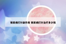 銀屑病打針副作用 銀屑病打針治療多少錢