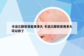 卡泊三醇軟膏能用多久 卡泊三醇軟膏用多久可以停了