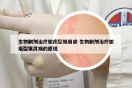 生物制劑治療膿皰型銀屑病 生物制劑治療膿皰型銀屑病的原理