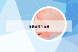 冬天會(huì)得牛皮癬