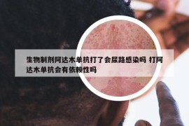 生物制劑阿達(dá)木單抗打了會(huì)尿路感染嗎 打阿達(dá)木單抗會(huì)有依賴性嗎