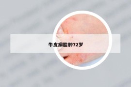 牛皮癬臉腫72歲