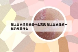 腿上出來很多癬是什么意思 腿上出來像癬一樣的那是什么