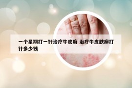 一個(gè)星期打一針治療牛皮癬 治療牛皮膚癬打針多少錢