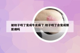 被蚊子咬了變成牛皮癬了 蚊子咬了會(huì)變成銀屑病嗎