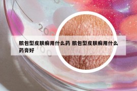 膿包型皮膚癬用什么藥 膿包型皮膚癬用什么藥膏好