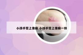 小孩手臂上像癬 小孩手臂上像癬一樣