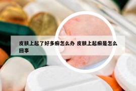 皮膚上起了好多癬怎么辦 皮膚上起癬是怎么回事