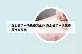 身上長(zhǎng)了一塊像癬怎么辦 身上長(zhǎng)了一塊像癬是什么原因