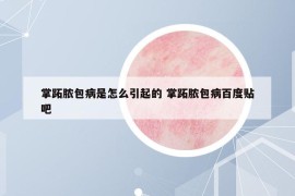 掌跖膿包病是怎么引起的 掌跖膿包病百度貼吧