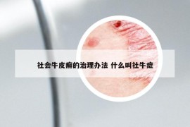 社會牛皮癬的治理辦法 什么叫社牛癥