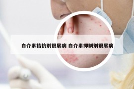 白介素拮抗劑銀屑病 白介素抑制劑銀屑病