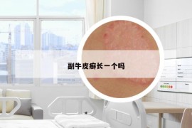 副牛皮癬長一個嗎