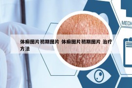 體癬圖片初期圖片 體癬圖片初期圖片 治療方法