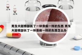 男生大腿根部長(zhǎng)了一塊像癬一樣的東西 男生大腿根部長(zhǎng)了一塊像癬一樣的東西怎么辦