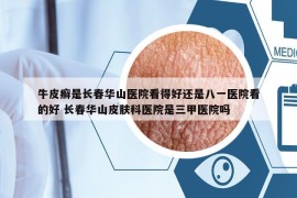 牛皮癬是長春華山醫(yī)院看得好還是八一醫(yī)院看的好 長春華山皮膚科醫(yī)院是三甲醫(yī)院嗎