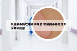 銀屑病不能吃哪些調(diào)味品 銀屑病不能吃什么水果和蔬菜